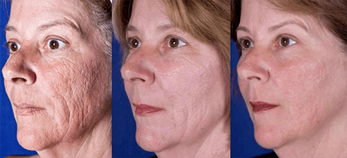 Le résultat après une procédure de rajeunissement de la peau du visage au laser