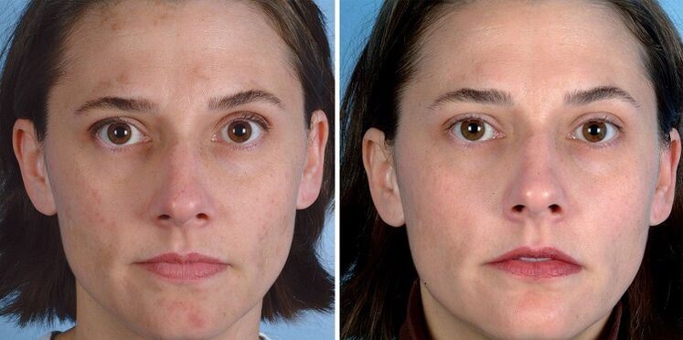 avant et après le rajeunissement de la peau avec des outils