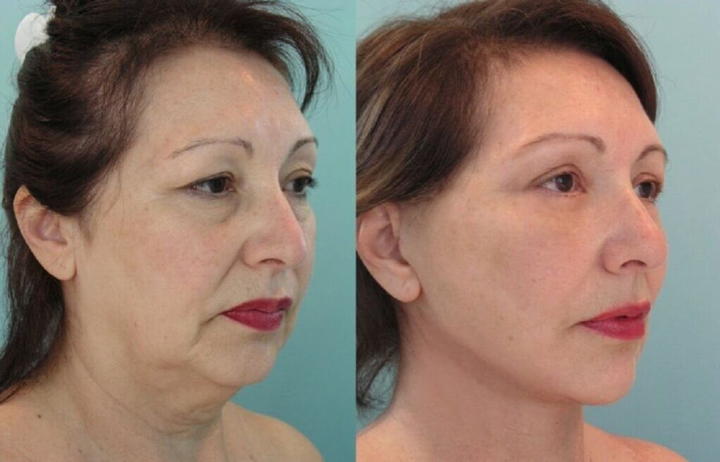 photos avant et après rajeunissement de la peau